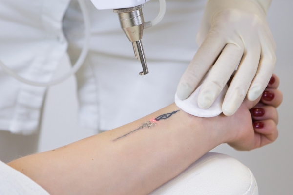 How Long Does It Take for a Tattoo to Heal After Laser Removal?
