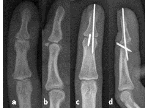 Surgical techniques for treatment of mallet finger with Kirschner wire obstruction and fixation