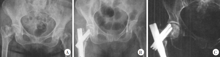 What are the factors causing failure of internal fixation in PFNA treatment of intertrochanteric fracture of femur?