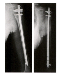Is Distal Locking of Humeral Shaft Intramedullary Nail Necessary?