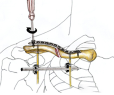 Minimally Invasive Plate Osteosynthesis (MIPO) for the Treatment of Midshaft Clavicle Fractures—Utilizing Lever Technique for Indirect Reduction
