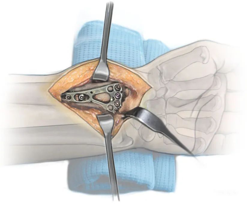 Henry Approach Volar Locking Plate Internal Fixation for the Treatment of Distal Radius Fractures