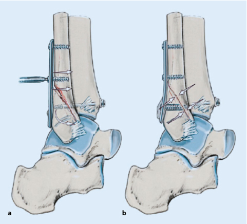 What Are The Precautions for Treating Ankle Fractures in Elderly Patients?