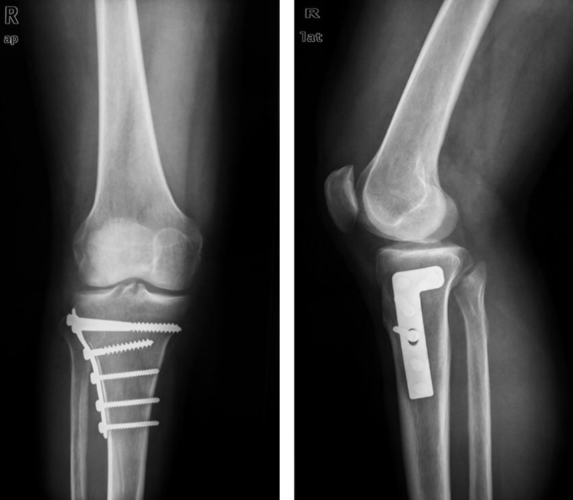 How to diagnose and treat tibial plateau fractures