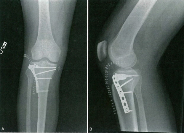 Schatzker And Hohl-Moore Classification Of Tibial Plateau Fractures