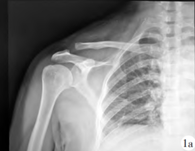 New Options for Treatment of Acromioclavicular Joint Dislocation—Three Internal Fixation Methods