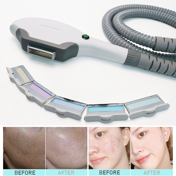 Multifunctional Laser opt shr ipl RF Laser Hair Removal Skin Treatment