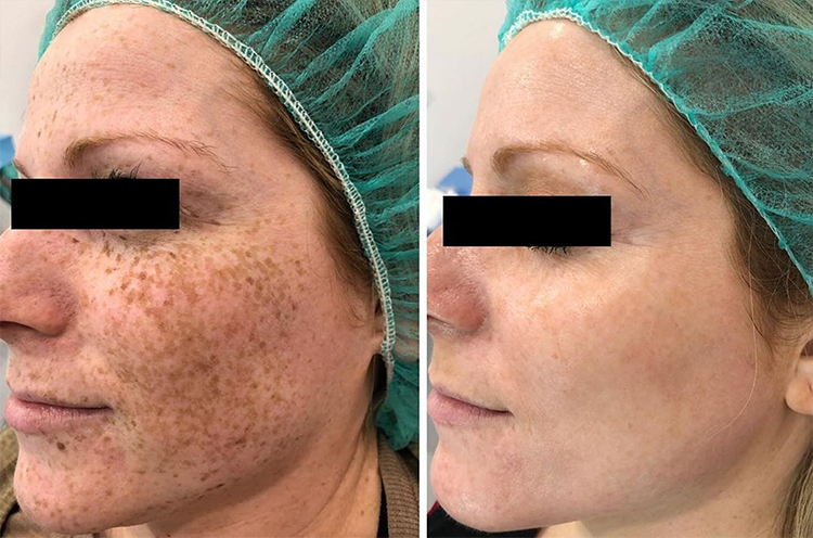 Is intense pulsed light (IPL therapy) really effective for dark spots and discoloration?