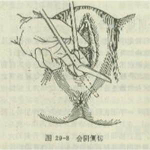 Manaʻo ʻia ʻo Gynecologic and Obstetric surgery suture