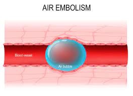 Minimal risk of embolism due to air bubbles in the IV line