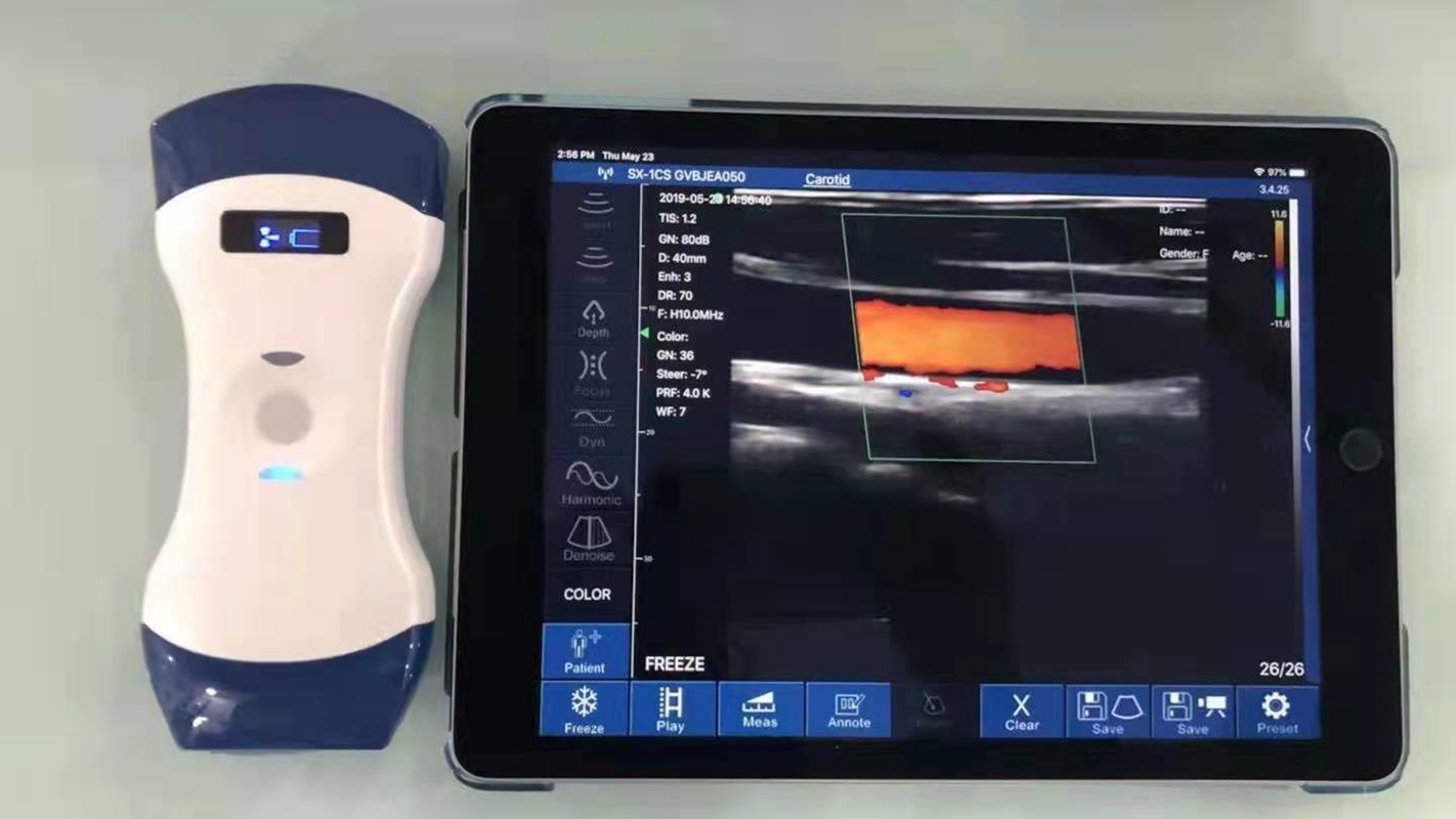 wireless ultrasound scanner for iphone