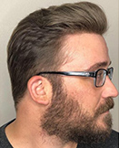 non-surgical-hair-replacement-phoenix