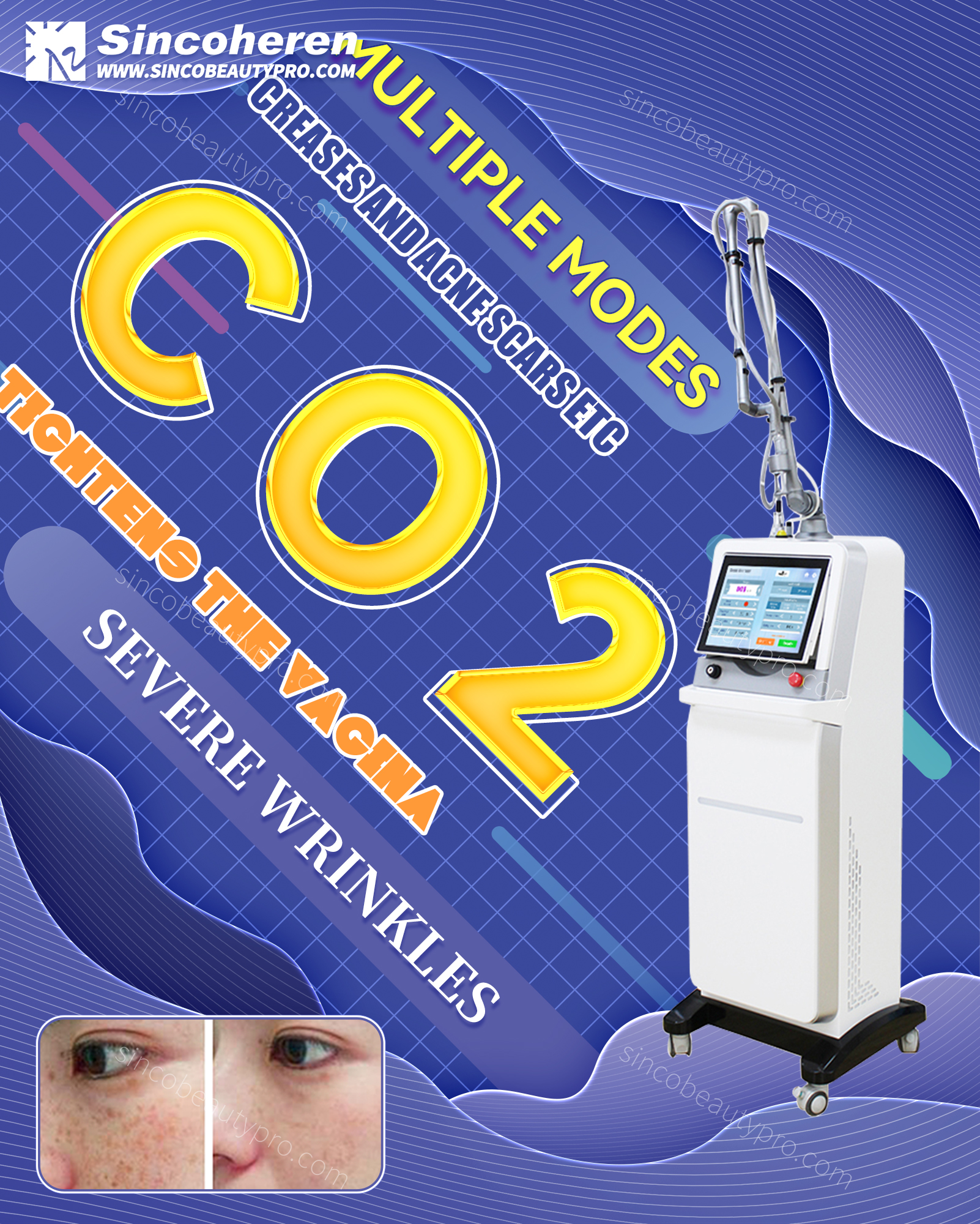 What is Fractional CO2 Laser?
