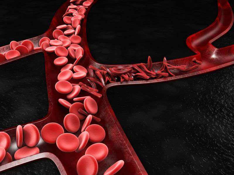 Vascular Embolism ၏ လက္ခဏာများ