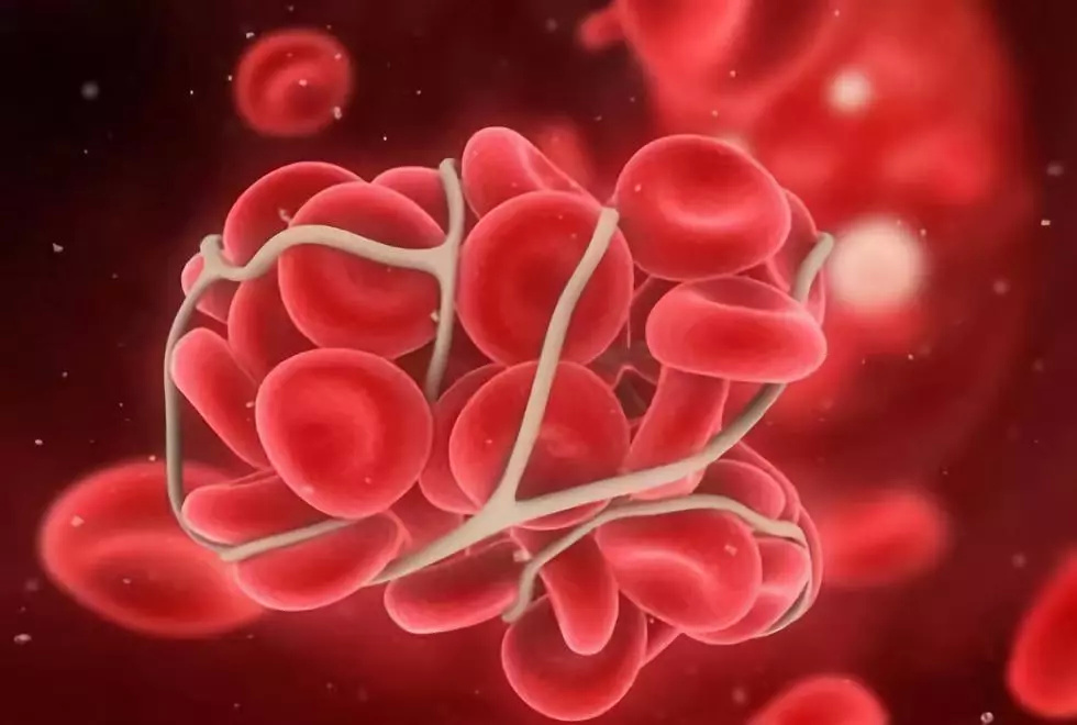 What is the most common thrombosis?