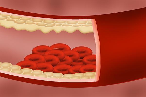 The Reasons Of Thrombosis