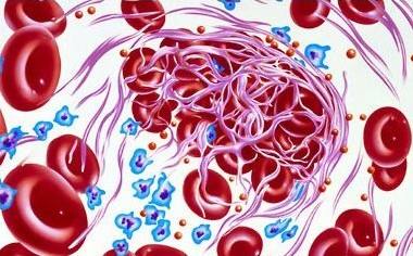 Kakšni so simptomi krvnih strdkov?