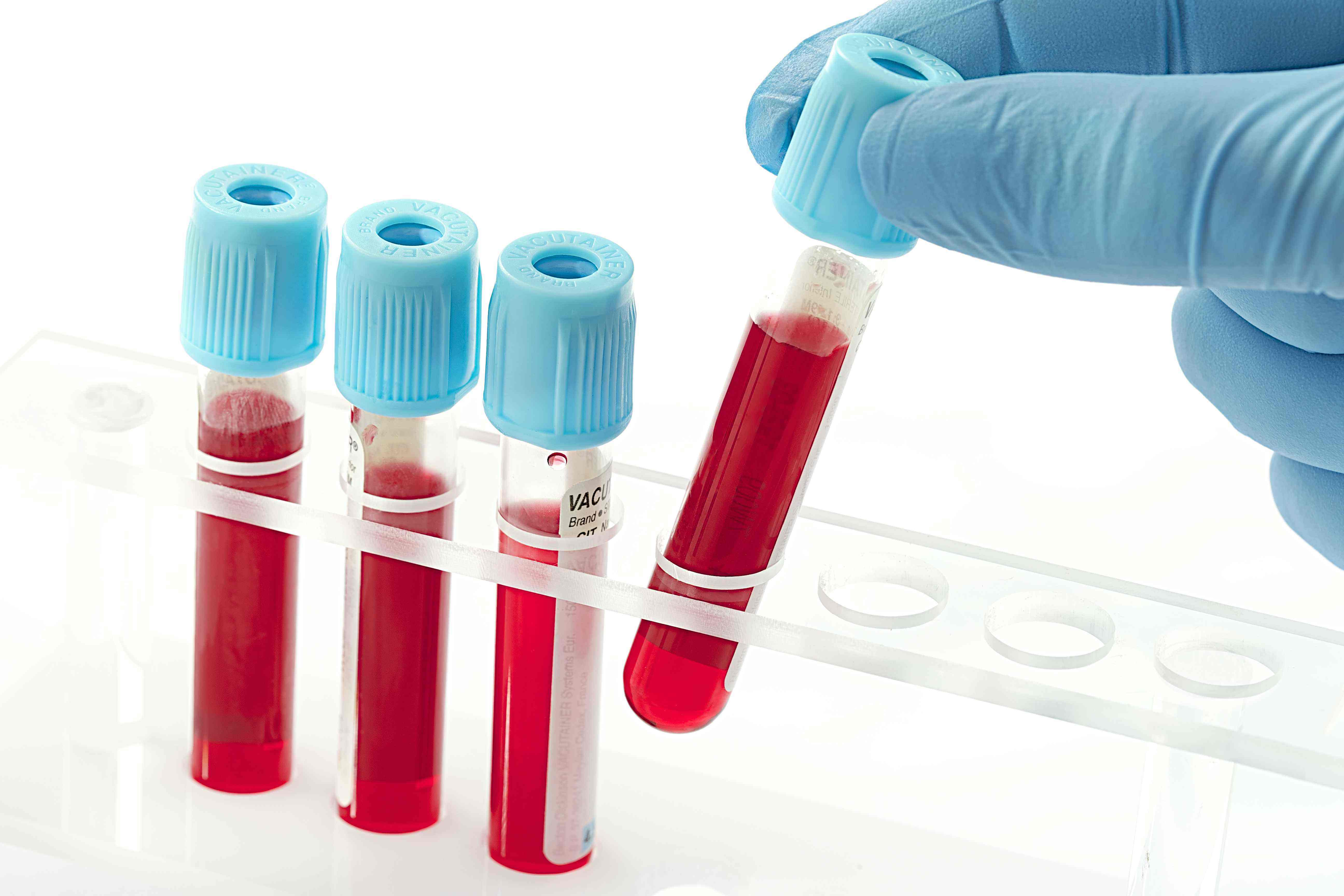 Клінічне значення тесту PT APTT FIB у хворих на гепатит B