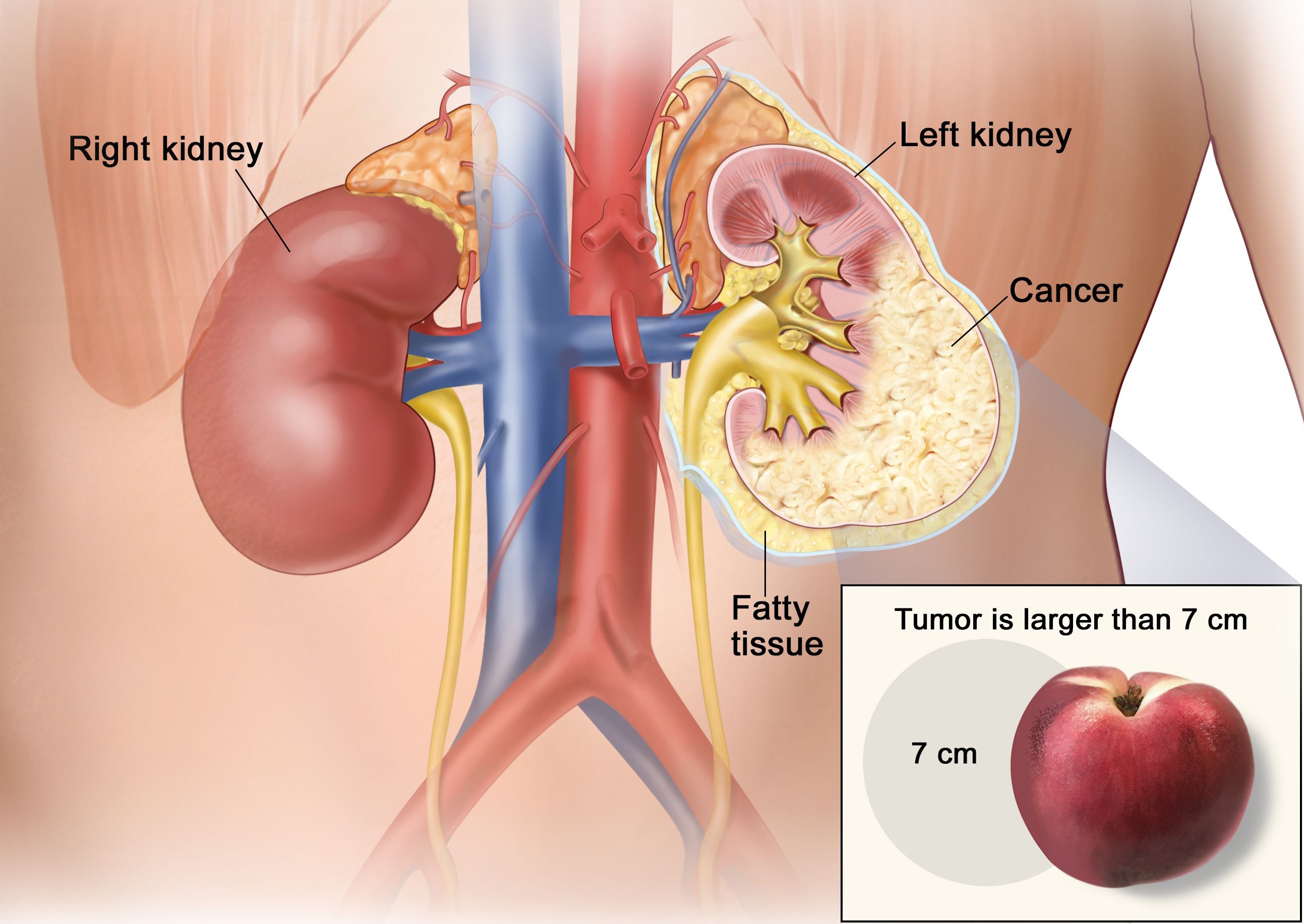 論文分享丨腎細胞癌新的潛在治療靶點